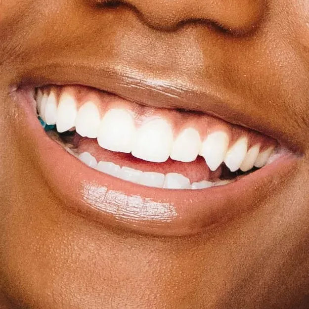 Sourire éclatant - blanchiment dentaire